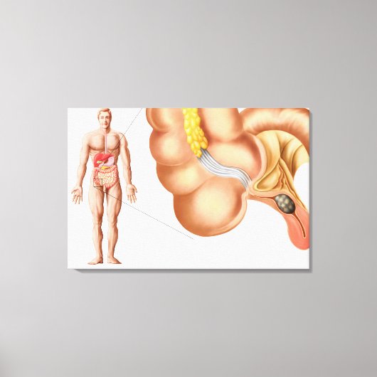 Toile Illustration Médicale D'Un Appendice (Recto)