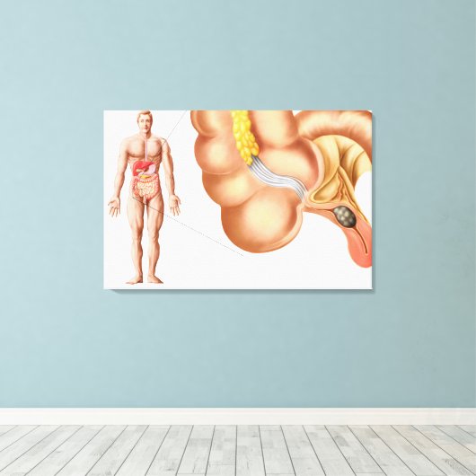 Toile Illustration Médicale D'Un Appendice (Insitu (Plancher de Bois))