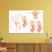 Toile Illustration Médicale D'Un Cyst Pilonidal (Insitu(Salon))