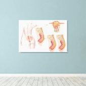 Toile Illustration Médicale D'Un Cyst Pilonidal (Insitu (Plancher de Bois))