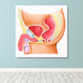 Toile Illustration Médicale D'Une Fistule Rectouréthrale (Insitu (Plancher de Bois))