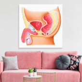 Toile Illustration Médicale D'Une Fistule Rectouréthrale (Insitu(Salon))