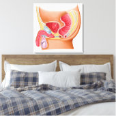 Toile Illustration Médicale D'Une Fistule Rectouréthrale (Insitu(Chambre))