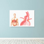 Toile Illustration Médicale D'Une Hernie Hiatal Dans (Insitu (Plancher de Bois))