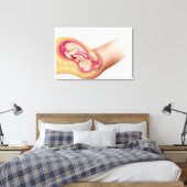 Toile Illustration Montrant La Livraison Du Foetus 2 (Insitu(Chambre))