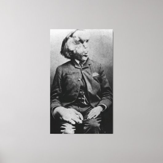 Toile Joseph "John" Merrick L'homme éléphant de 1889 (Recto)
