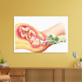 Toile Livraison Du Foetus À L'Aide De L'Extraction Vacue (Insitu(Salon))