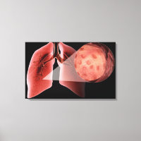 Piste gonflée pendant une crise d'asthme