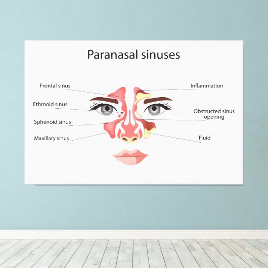 Toile sinus paranasal (Insitu (Plancher de Bois))
