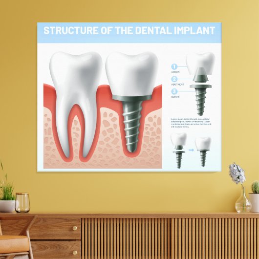 Toile Structure de l'implant dentaire (Insitu(Salon))