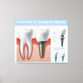 Toile Structure de l'implant dentaire (Recto)