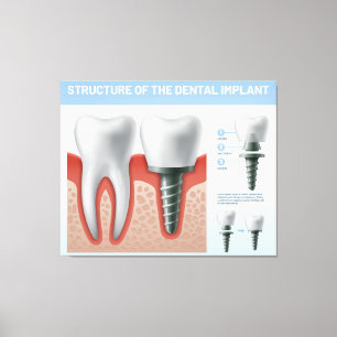 Toile Structure de l'implant dentaire