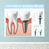 Toile Structure de l'implant dentaire (Insitu (Plancher de Bois))