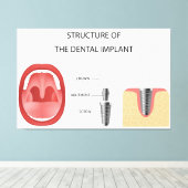 Toile Structure de l'implant dentaire (Insitu (Plancher de Bois))