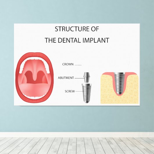 Toile Structure de l'implant dentaire (Insitu (Plancher de Bois))