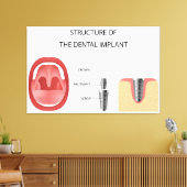 Toile Structure de l'implant dentaire (Insitu(Salon))