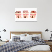 Toile Vue des causes de l'acné (Insitu(Chambre))