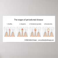 Tooth Periodontal Disease Poster
