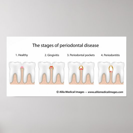 Tooth Periodontal Disease Poster (Devant)