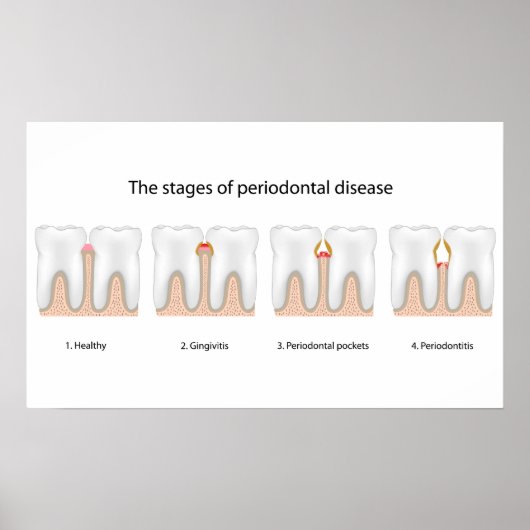 Tooth Periodontal Disease Poster (Devant)