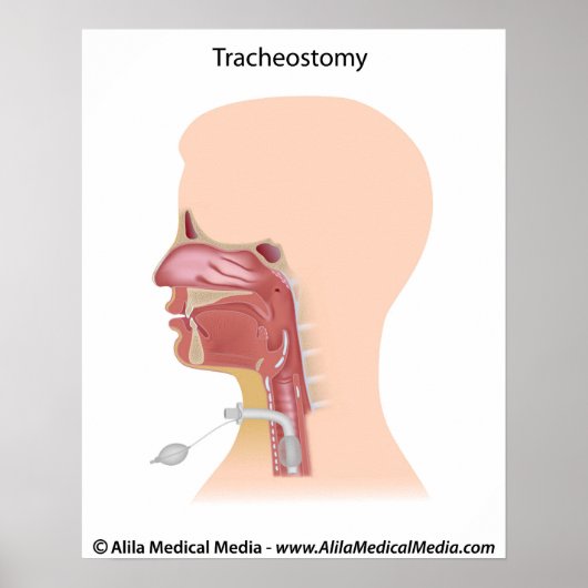 Tracheostomy tekening. poster (Voorkant)