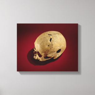 Trepaned Skull Canvas Afdruk