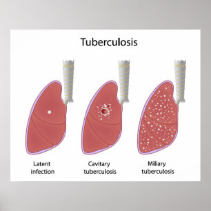 Tuberculose type Poster