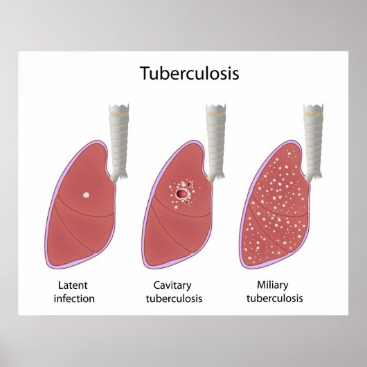Types de tuberculose Poster (Devant)
