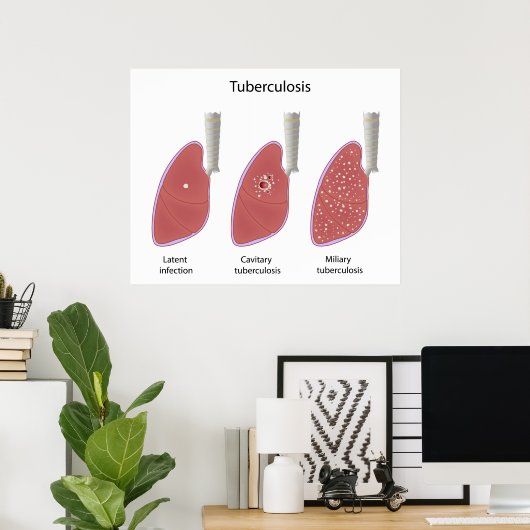 Types de tuberculose Poster (Bureau à domicile)