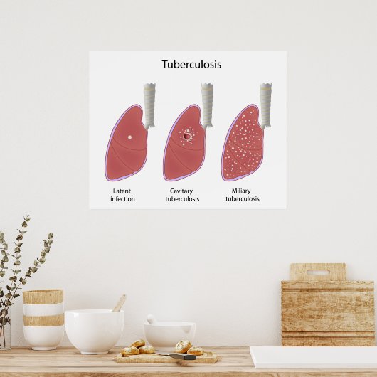 Types de tuberculose Poster (Cuisine)