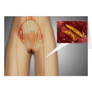 Verkleinde arterie nabij been