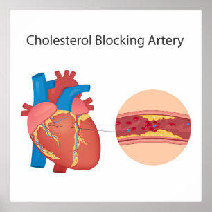 Vernauwde bloedvaten poster