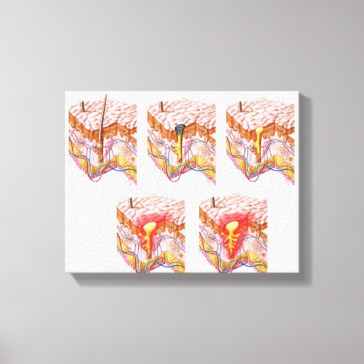 Verschillende soorten Acne Canvas Afdruk (Voorkant)