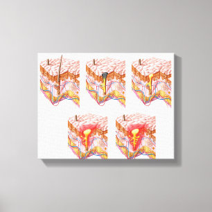 Verschillende soorten Acne Canvas Afdruk