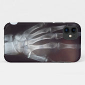 X Ray Hand Phone Case (Achterkant (horizontaal))
