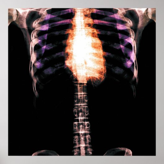 X-RAY SKELETON TORSO RIBS - ORIGINEEL POSTER (Voorkant)