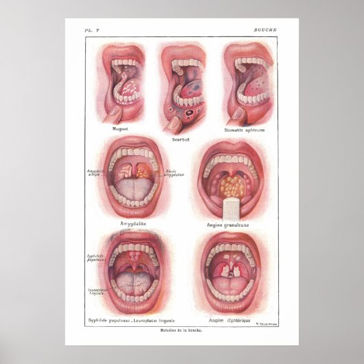 Ziekten van Poster van de anatomie in de mond (Voorkant)